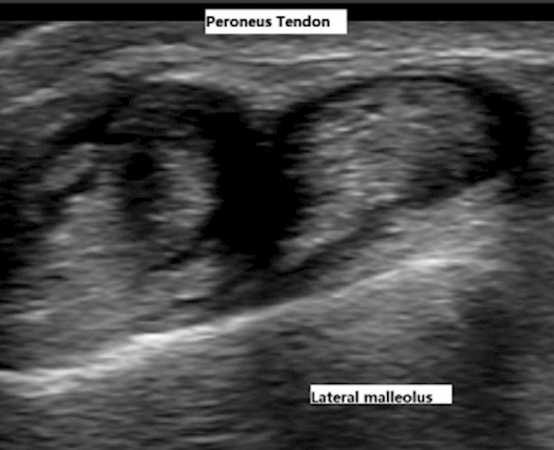 Traumatic dislocation of the peroneal tendons